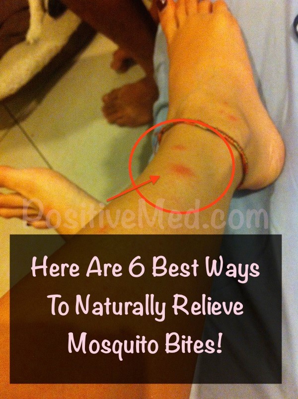 Mosquito Bite Remedies