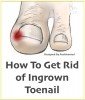 How To Get Rid of Ingrown Toenail