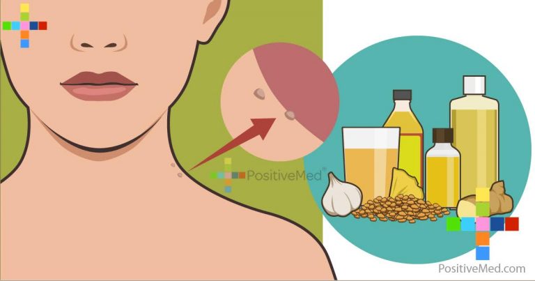 Skin Tags Natural Treatments Skin Tags Natural Treatments