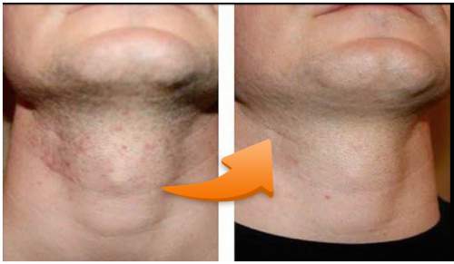 Razor Bumps, Causes and Treatments