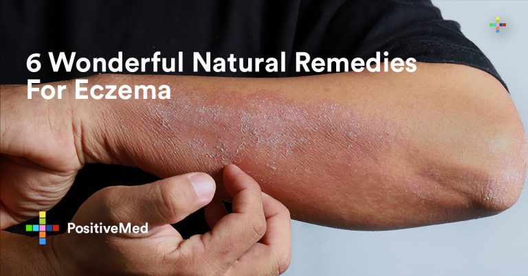 6 Wonderful Natural Remedies For Eczema 6 Wonderful Natural Remedies For Eczema