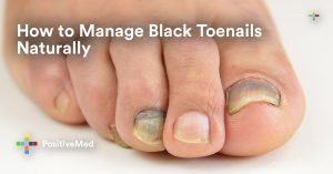 How to Manage Black Toenails Naturally.