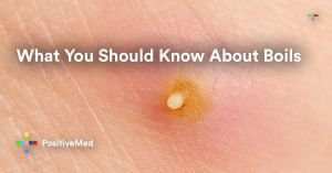 What You Should Know About Boils