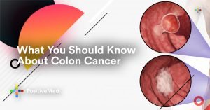 What You Should Know About Colon Cancer