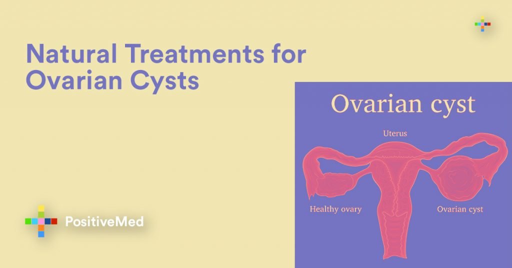 Natural Treatments for Ovarian Cysts