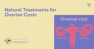 Natural Treatments for Ovarian Cysts