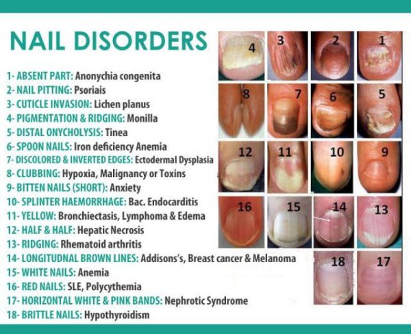 4. Nail Bed Color and Iron Deficiency Anemia - wide 8