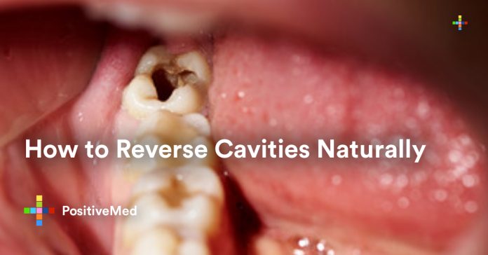 How to Reverse Cavities Naturally