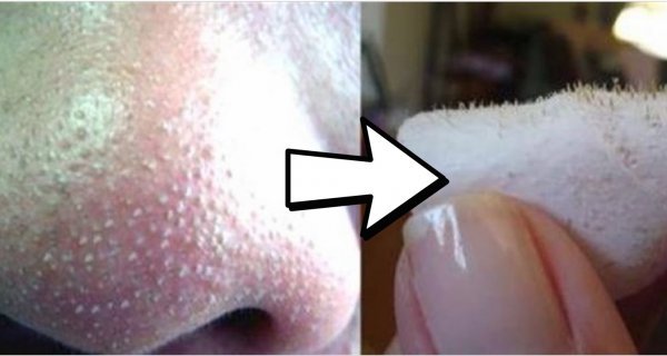 How To Get Rid Of Blackheads And Minimize Pores Without Using Any Chemicals