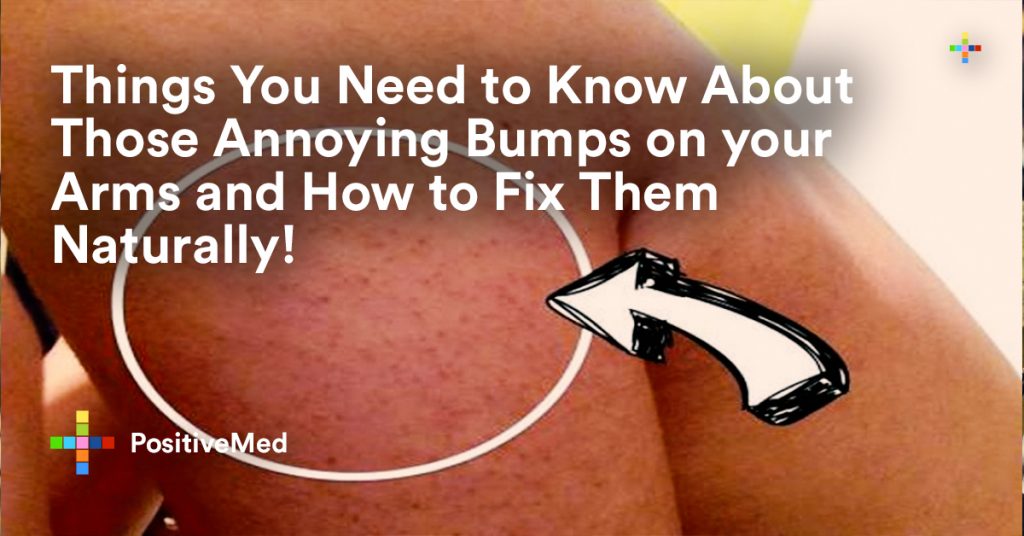 Things You Need to Know About Those Annoying Bumps on your Arms and How to Fix Them Naturally!