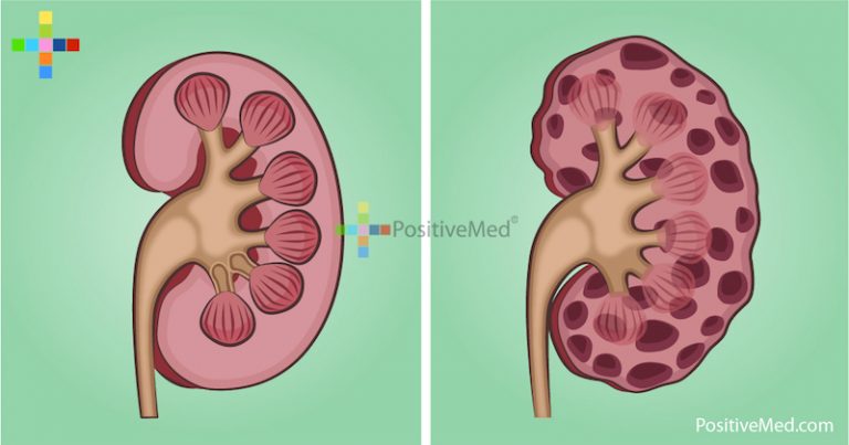 10 Signs and Symptoms of Kidney Disease, the Silent Killer, You Should Never Ignore