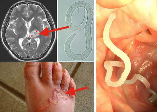 See How These Internal Parasites Are Eating You Alive