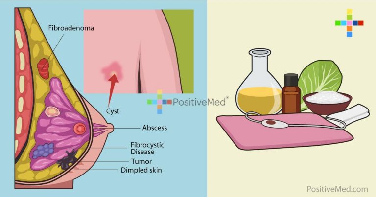 6 Natural Remedies To Get Rid Of Breast Cysts 6 Natural Remedies To Get Rid Of Breast Cysts