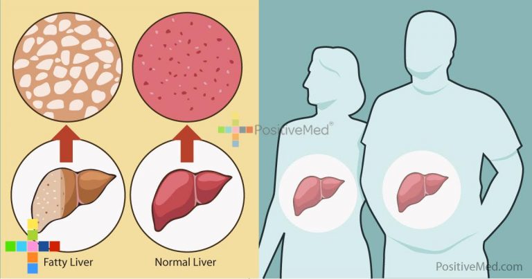 Many People Unknowingly Have Non-Alcoholic Fatty Liver Disease. Are You One of Them? Many People Unknowingly Have Non-Alcoholic Fatty Liver Disease. Are You One of Them?