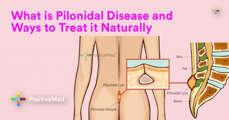 What is Pilonidal Disease and Ways to Treat it Naturally