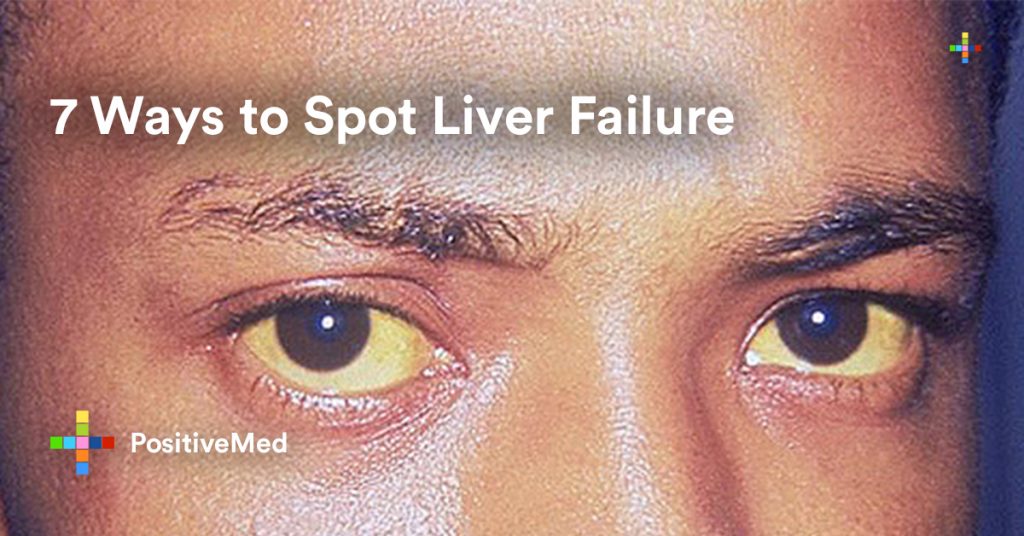 7 Ways to Spot Liver Failure