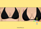 Get Breast Enlargement Without Surgery