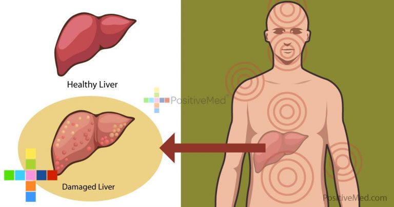 12 Body Signals About Liver Damage 12 Body Signals About Liver Damage