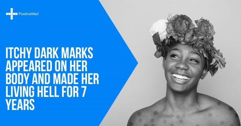 Itchy Dark Marks Appeared on Her Body and Made Her Living Hell for 7 Years Itchy Dark Marks Appeared on Her Body and Made Her Living Hell for 7 Years