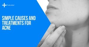 Simple Causes and Treatments for Acne