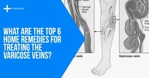 What are the Top 6 Home Remedies for Treating the Varicose Veins