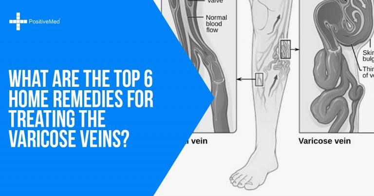 What are the Top 6 Home Remedies for Treating the Varicose Veins? What are the Top 6 Home Remedies for Treating the Varicose Veins?