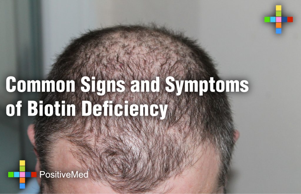 Common Signs and Symptoms of Biotin Deficiency