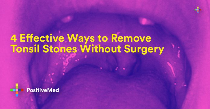 4 Effective Ways to Remove Tonsil Stones Without Surgery
