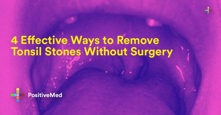 4 Effective Ways To Remove Tonsil Stones Without Surgery