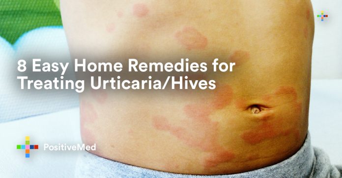 8 Easy Home Remedies for Treating Urticaria Hives.