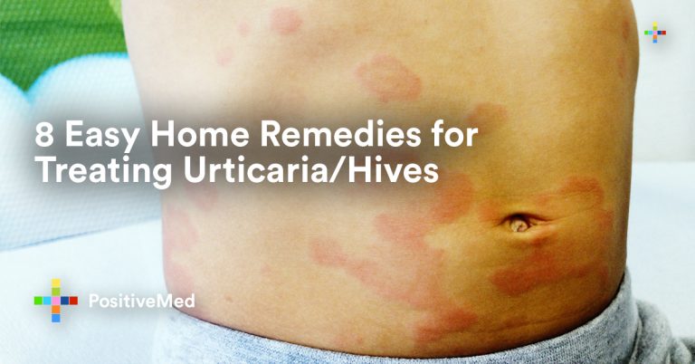 8 Easy Home Remedies for Treating Urticaria/Hives