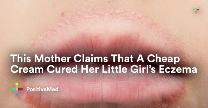This Mother Claims That A Cheap Cream Cured Her Little Girl’s Eczema