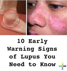 10 Early Warning Signs of Lupus You Need to Know