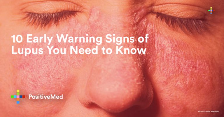10 Early Warning Signs of Lupus You Need to Know 10 Early Warning Signs of Lupus You Need to Know