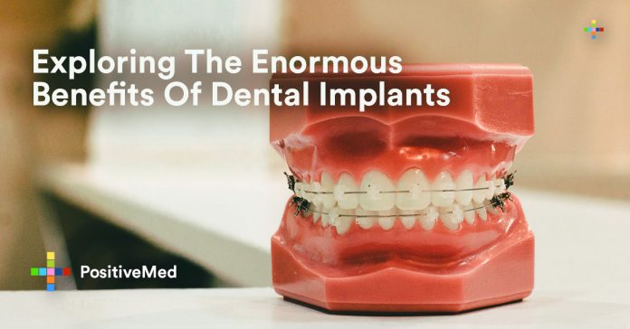 Exploring The Enormous Benefits of Dental Implants.