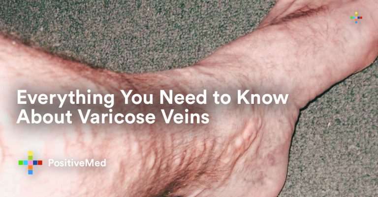 Everything You Need to Know About Varicose Veins