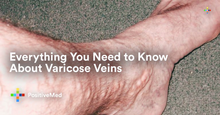 Everything You Need to Know About Varicose Veins Everything You Need to Know About Varicose Veins