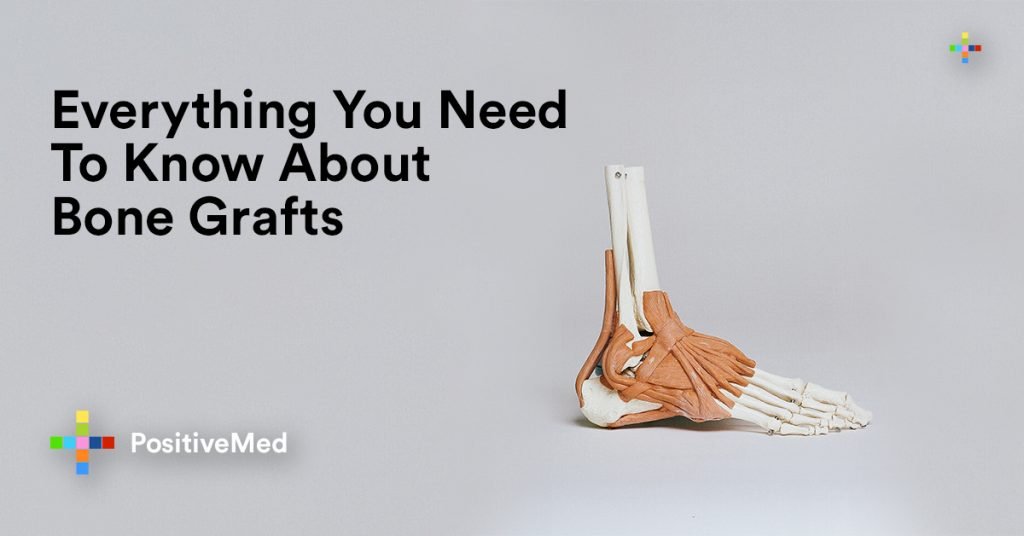Everything You Need To Know About Bone Grafts