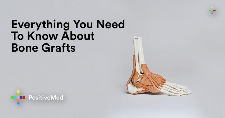 Everything You Need To Know About Bone Grafts Everything You Need To Know About Bone Grafts