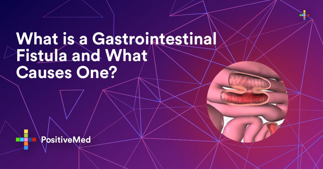 What is a Gastrointestinal Fistula and What Causes One? PositiveMed