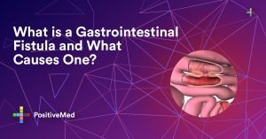 What is a Gastrointestinal Fistula and What Causes One