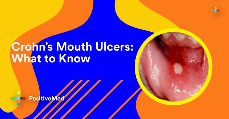 What You Need to Know about Crohn’s Mouth Ulcers