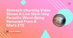 Stomach-churning Video Shows A Live 15cm-long Parasitic Worm Being Removed From A Man's EYE