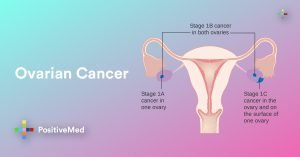 7 Ovarian Cancer Signs That Are Incredibly Easy To Miss