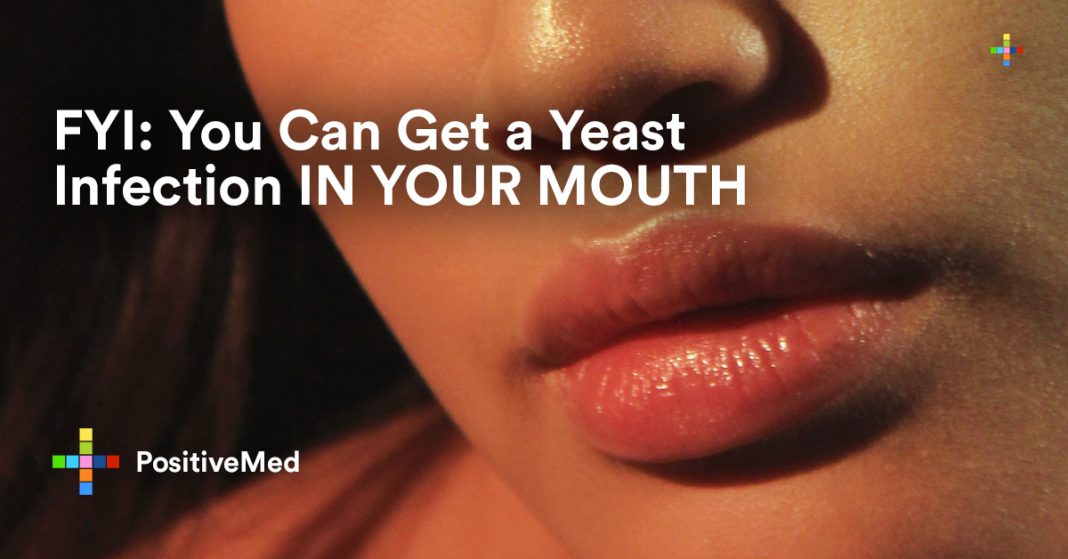 Can You Get a Yeast Infection in Your Mouth? PositiveMed