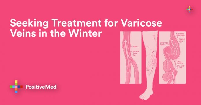 Seeking Treatment for Varicose Veins in the Winter