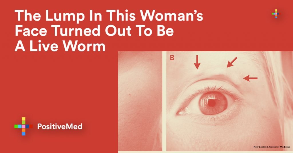 The Lump In This Woman's Face Turned Out To Be A Liveworm
