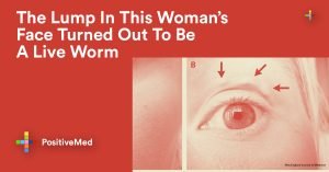 The Lump In This Woman's Face Turned Out To Be A Liveworm