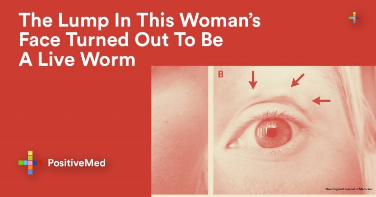 The Lump In This Woman’s Face Turned Out To Be A Liveworm