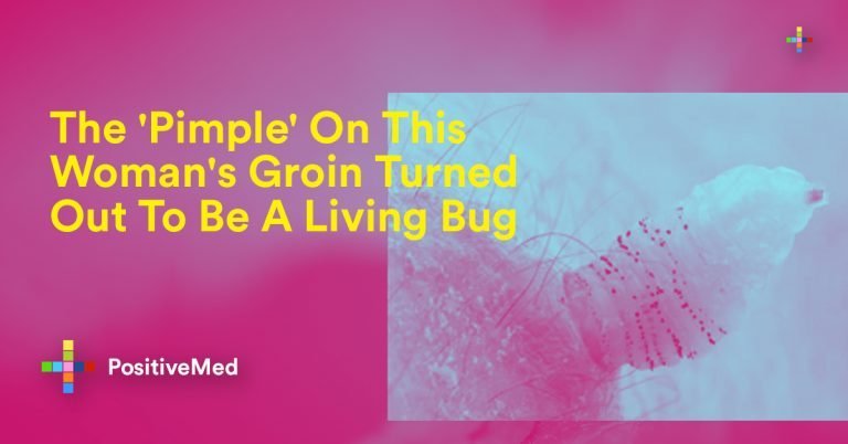 The ‘Pimple’ On This Woman’s Groin Turned Out To Be A living bug The ‘Pimple’ On This Woman’s Groin Turned Out To Be A living bug